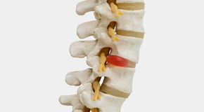 Montreal chiropractic conservative care helps even huge disc herniations go away