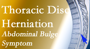 Dr. Hoang's Chiropractic Clinic cares for thoracic disc herniation that for some patients prompts abdominal pain.