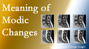 Dr. Hoang's Chiropractic Clinic sees many back pain and neck pain patients who bring their MRIs with them to the office. Modic changes are often seen. 