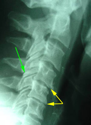 disc degeneration treated at Dr. Hoang's Chiropractic Clinic