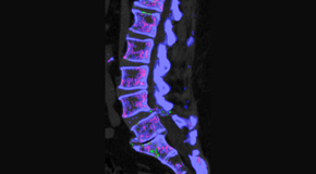 Dr. Hoang's Chiropractic Clinic is aware that inflammatory spinal gout is a differential diagnosis to consider for patients who present with back pain and other spine related symptoms.