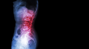 Montreal Chiropractic Care of Spondylolisthesis 