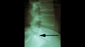 Montreal spondylolisthesis 