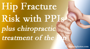 Dr. Hoang's Chiropractic Clinic shares new research describing higher risk of hip fracture with proton pump inhibitor use. 
