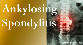 Ankylosing spondylitis is gently cared for by your Montreal chiropractor.