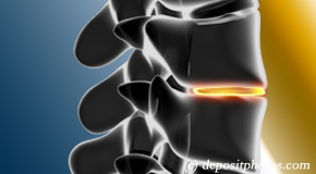 Montreal degenerative spinal changes 