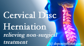 Dr. Hoang's Chiropractic Clinic offers the Cox® Technic spinal manipulation to treat cervical radiculopathy and avert surgery. 