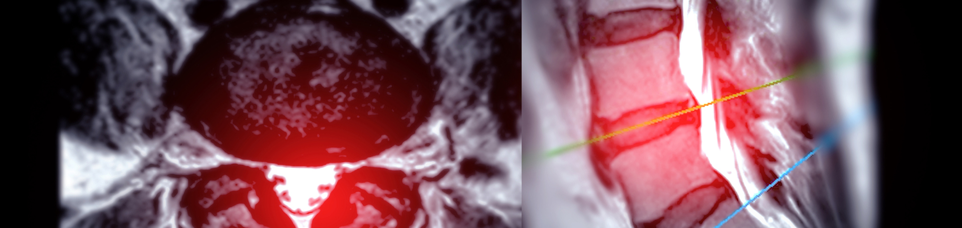 Montreal back pain imaging and exercise