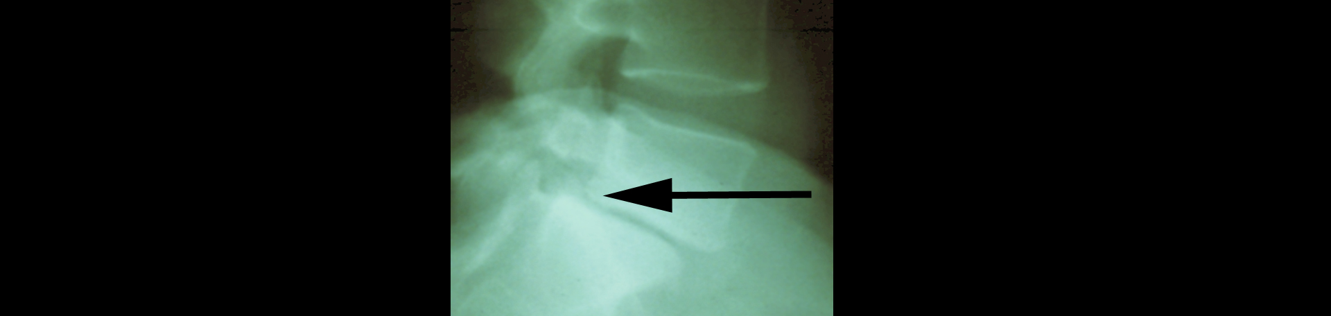 Montreal spondylolisthesis 