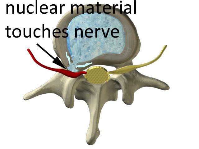 inner nuclear material of the disc touches the spinal nerve to cause pain