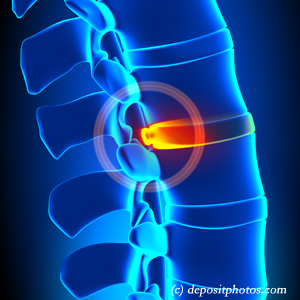 image of lumbar Montreal disc herniation