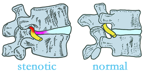 Montreal stenotic and normal spinal discs